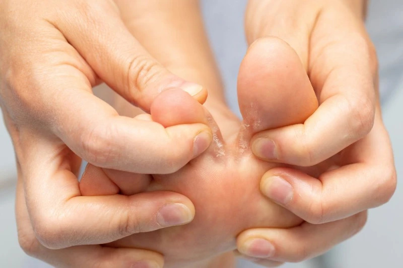 Athlete's foot care