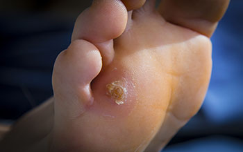 Corns and calluses