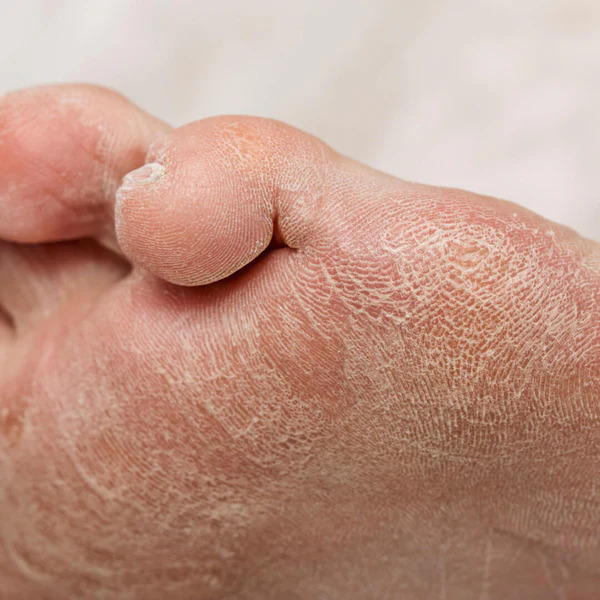 Dry skin care