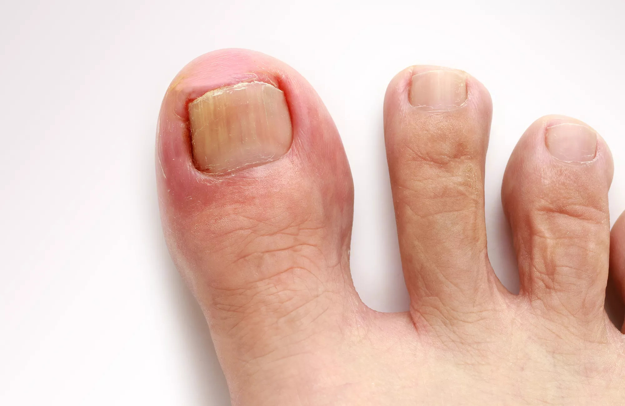 Ingrown toenail care